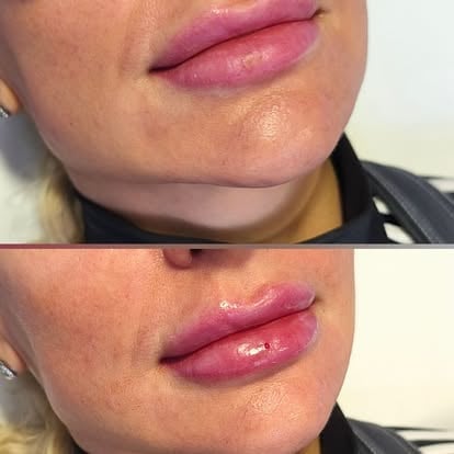 Before and after comparison of lip augmentation showing fuller, more defined lips with enhanced volume